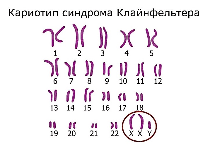 Кариопти при синдроме Клайнфельтера