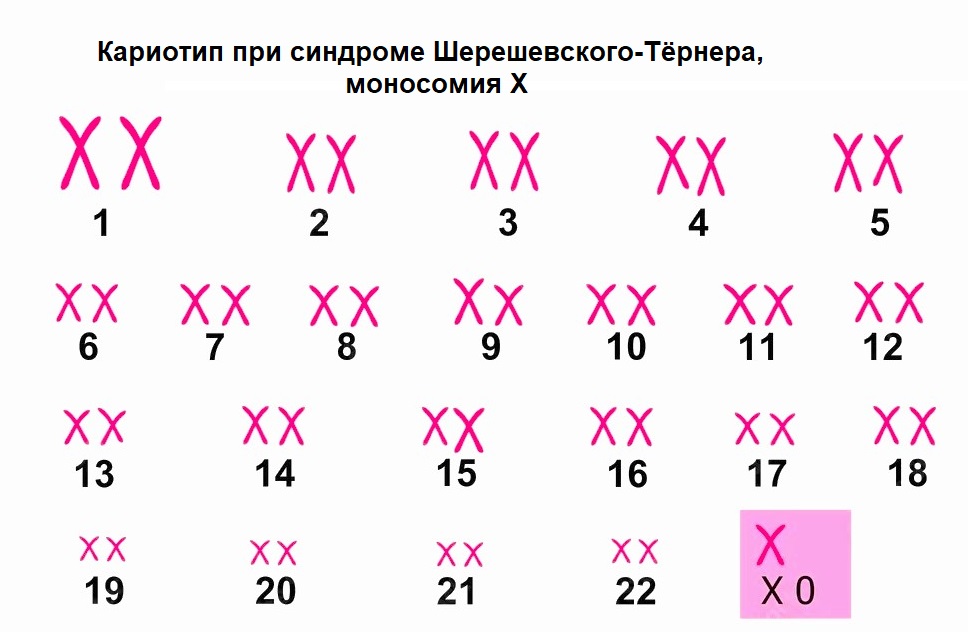 Кариотип при синдроме Тёрнера
