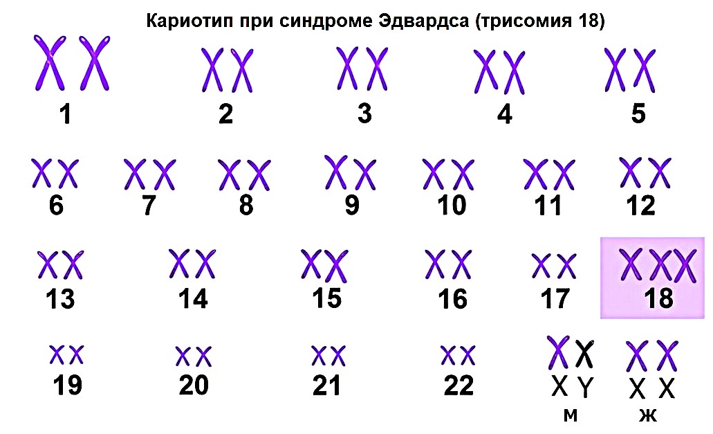Кариотип синдром Эдвардса