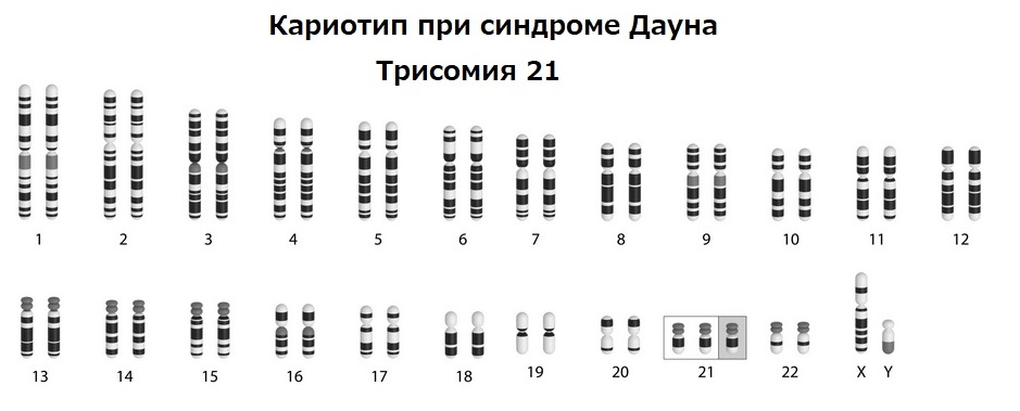 Кариотип при синдроме Дауна